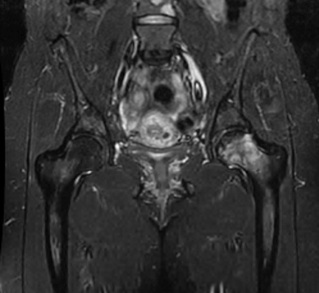 Figure 3 for case MALT lymphoma